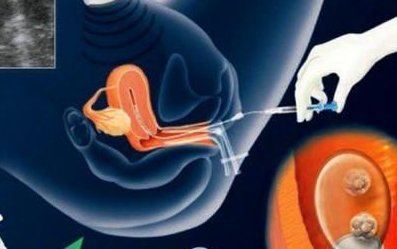 柬埔寨皇家生殖遗传医院金边医院洗精费用多少钱？试管婴儿移植成功后检查流程有哪些？