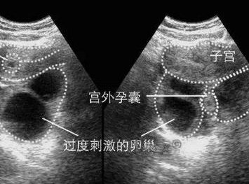 湖北三代试管技术价格目录参考及试管限制条件分析