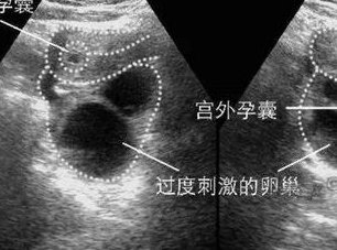 2026在襄阳市罗氏易位能做三代试管婴儿生子吗，相互易位和罗氏易位有什么区别？